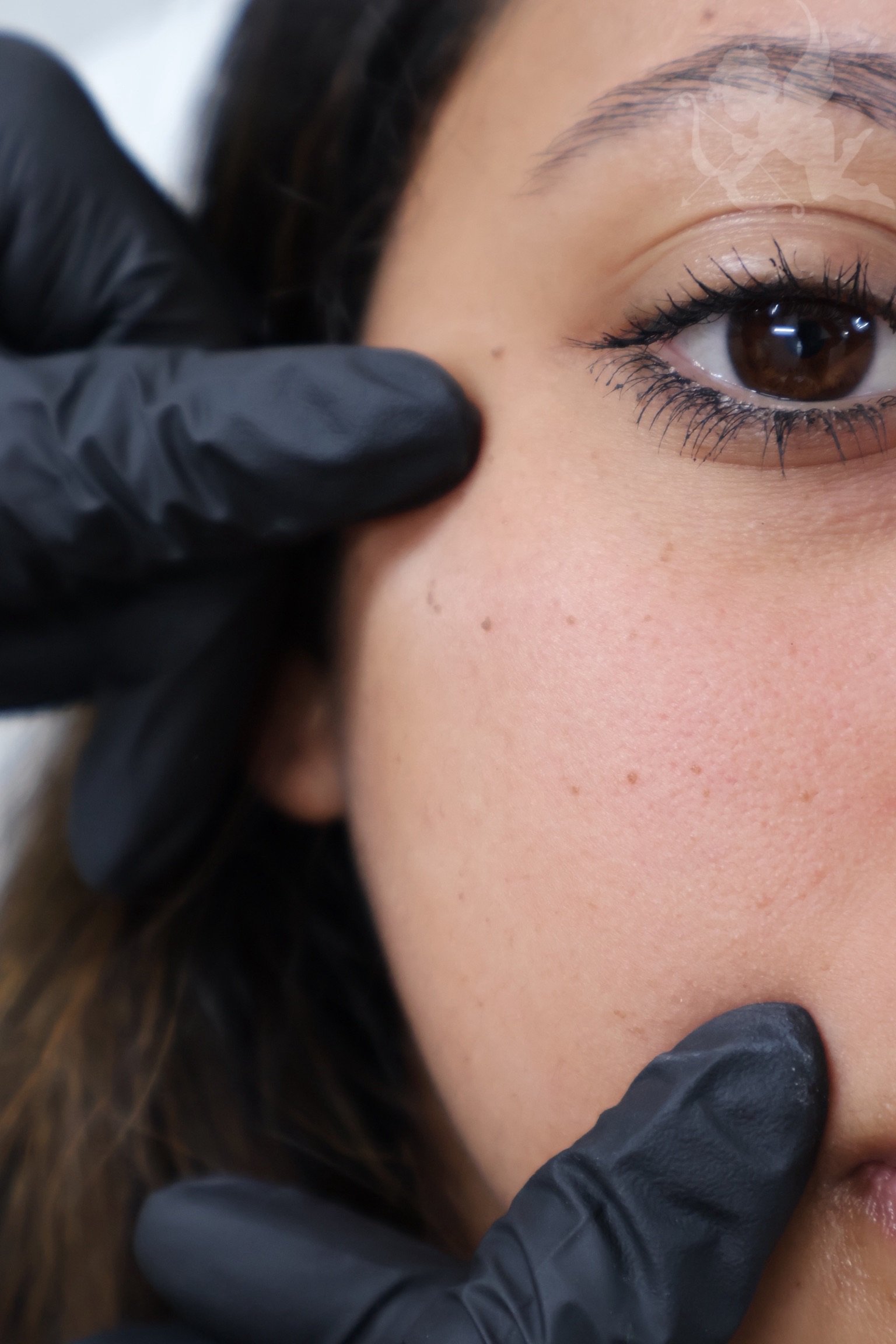 Rejuran PDRN skin healing treatment at Angelic Cosmetic Clinic, Kogarah NSW