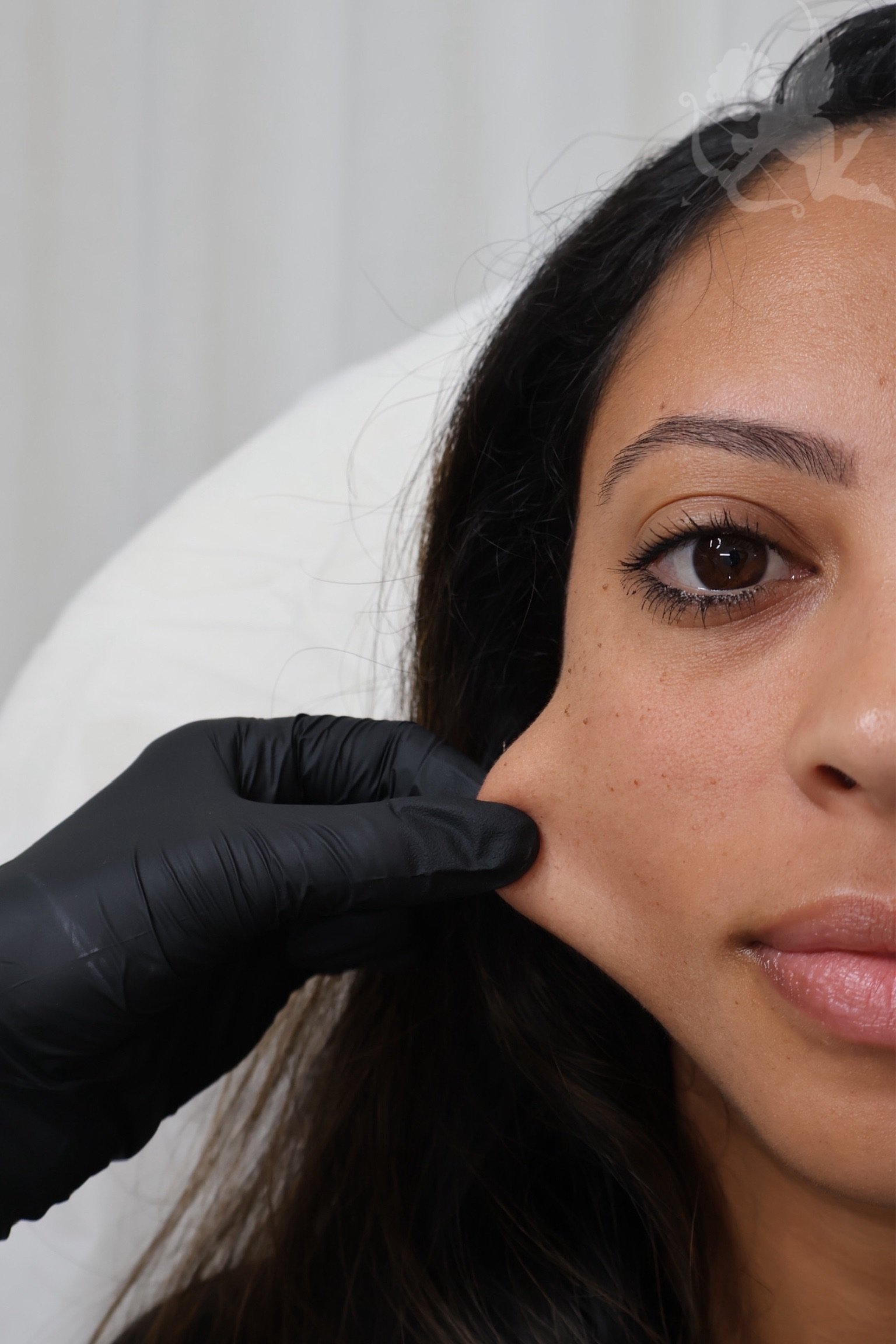 Bio stimulator collagen treatment at Angelic Cosmetic Clinic, Kogarah NSW