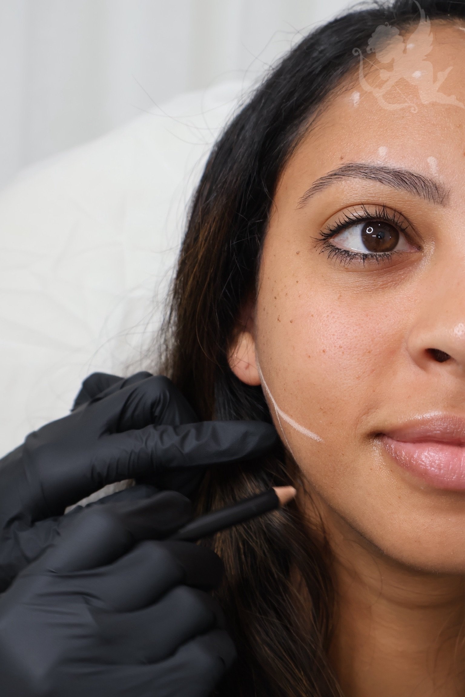 Facial mapping for thread lift treatment at Angelic Cosmetic Clinic