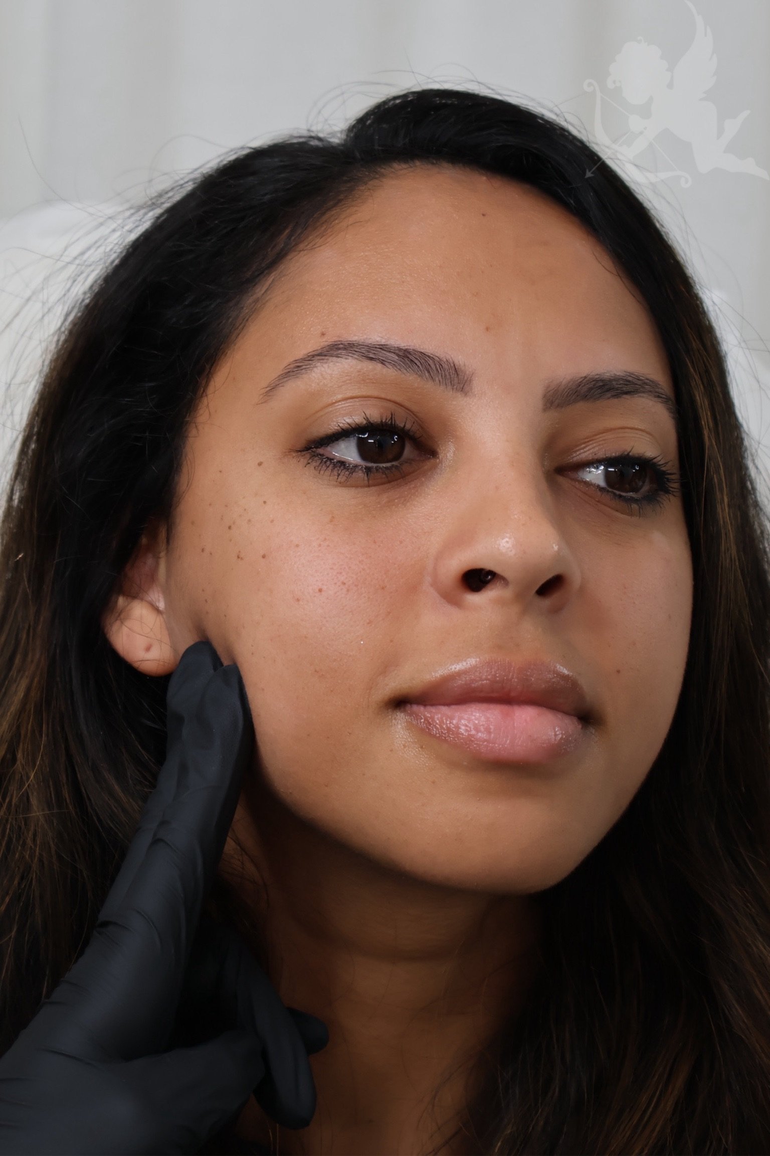 Bruxism treatment at Angelic Cosmetic Clinic, Kogarah NSW