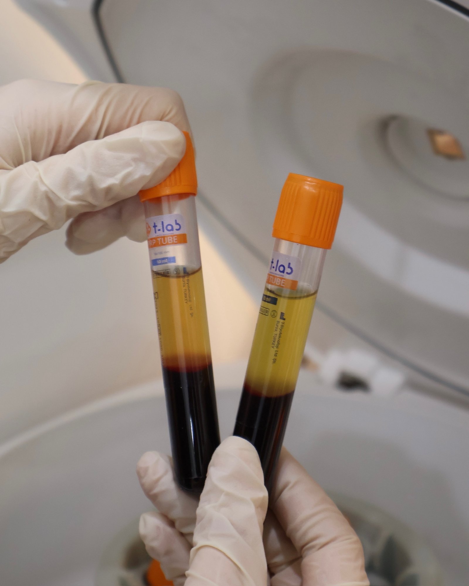 PRP PRF regenerative therapy