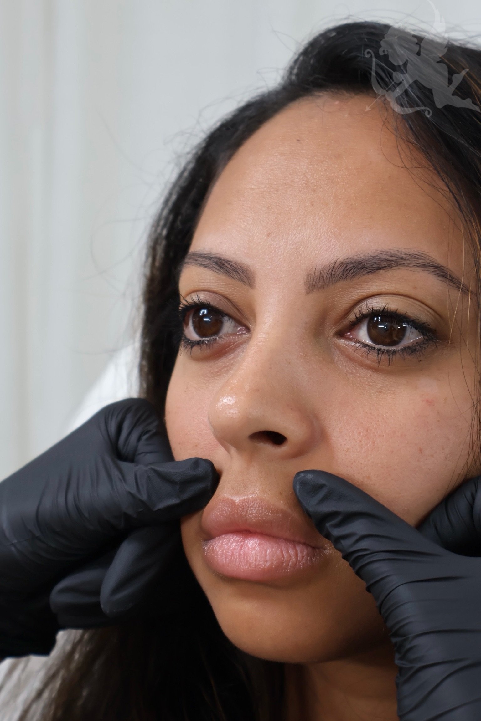 Volume replacement treatment at Angelic Cosmetic Clinic, Kogarah NSW