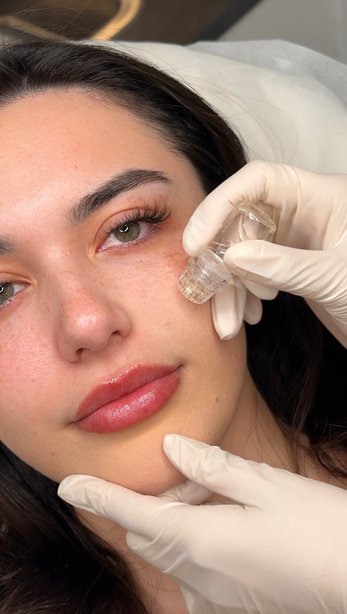 Skin booster mesotherapy treatment